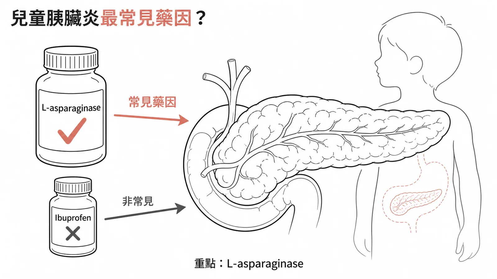兒童急性胰臟炎常見藥物原因非 Ibuprofen 示意圖