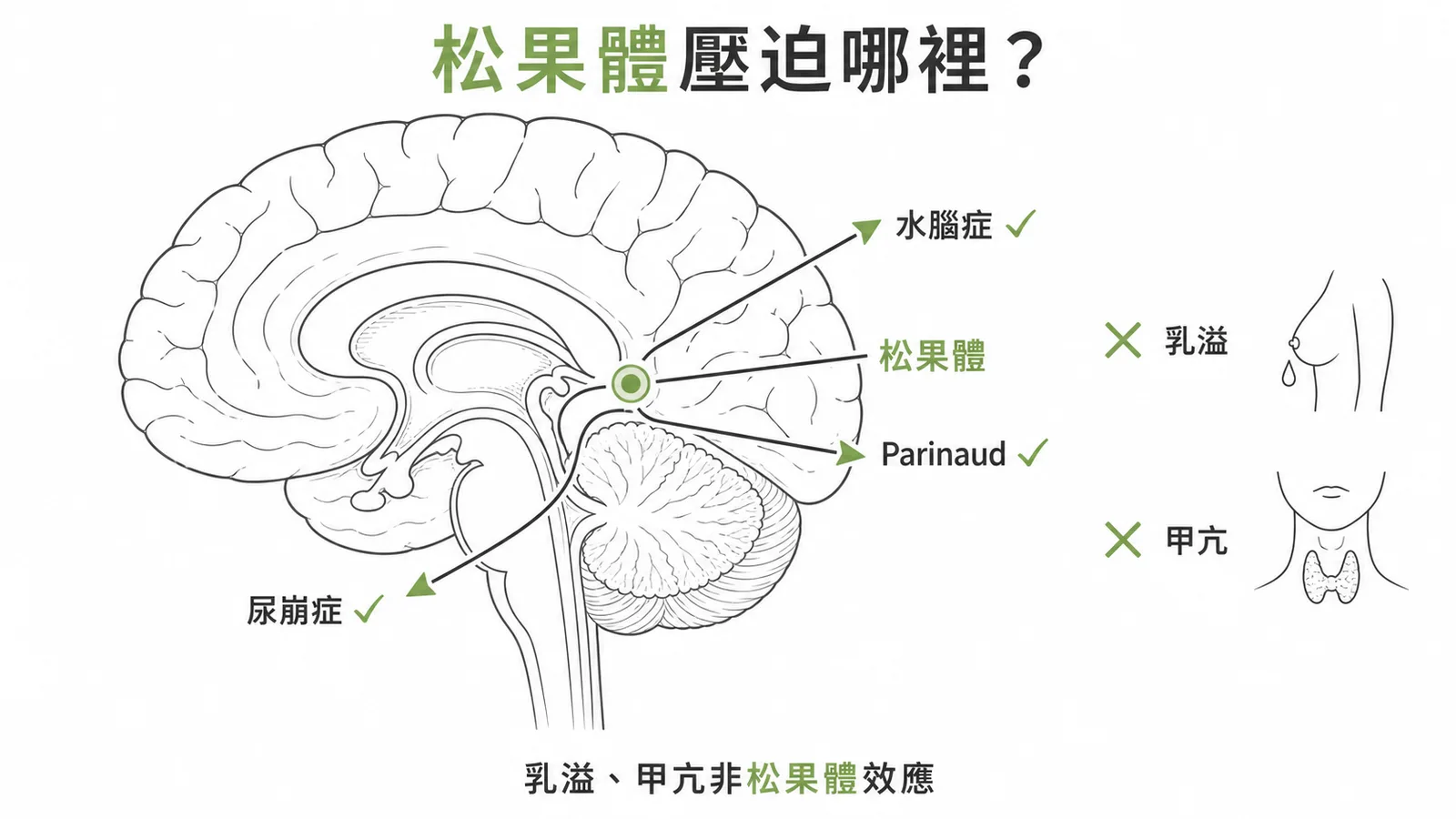 松果體腫瘤不會引起乳溢或甲狀腺機能亢進