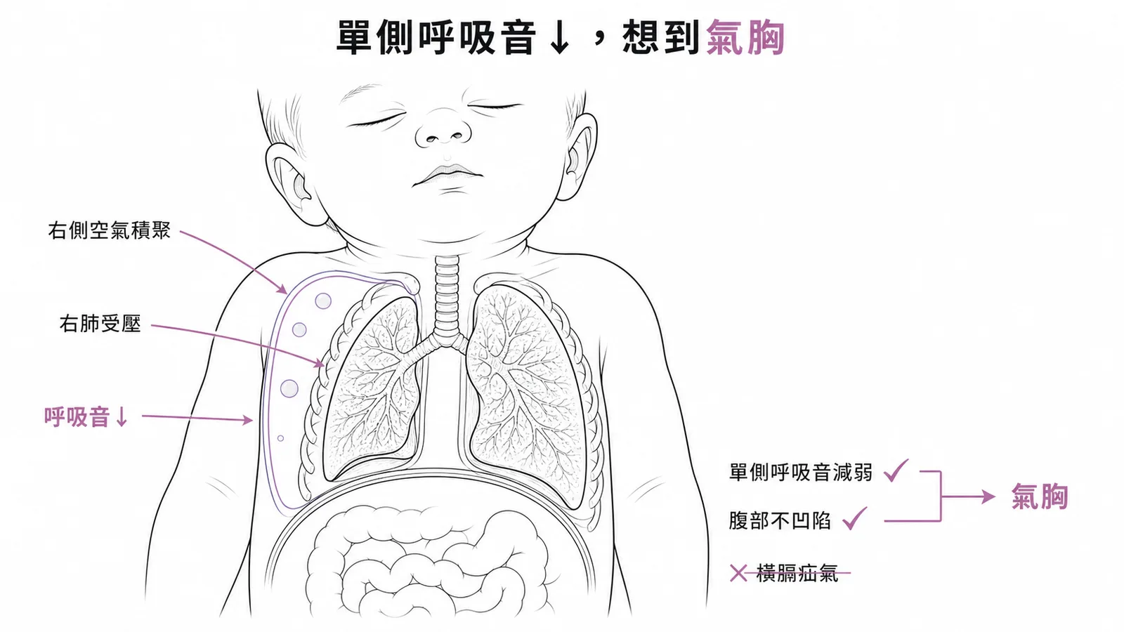 新生兒單側呼吸音減弱且無腹部凹陷指向氣胸