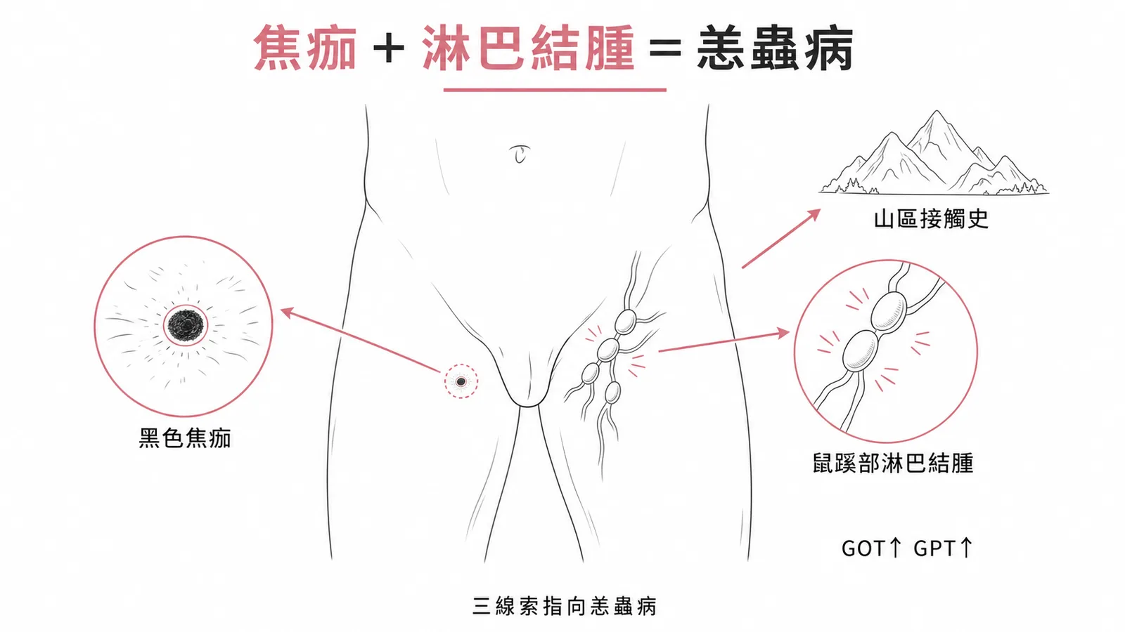 恙蟲病診斷三要素:山區接觸史加焦痂加局部淋巴結腫大