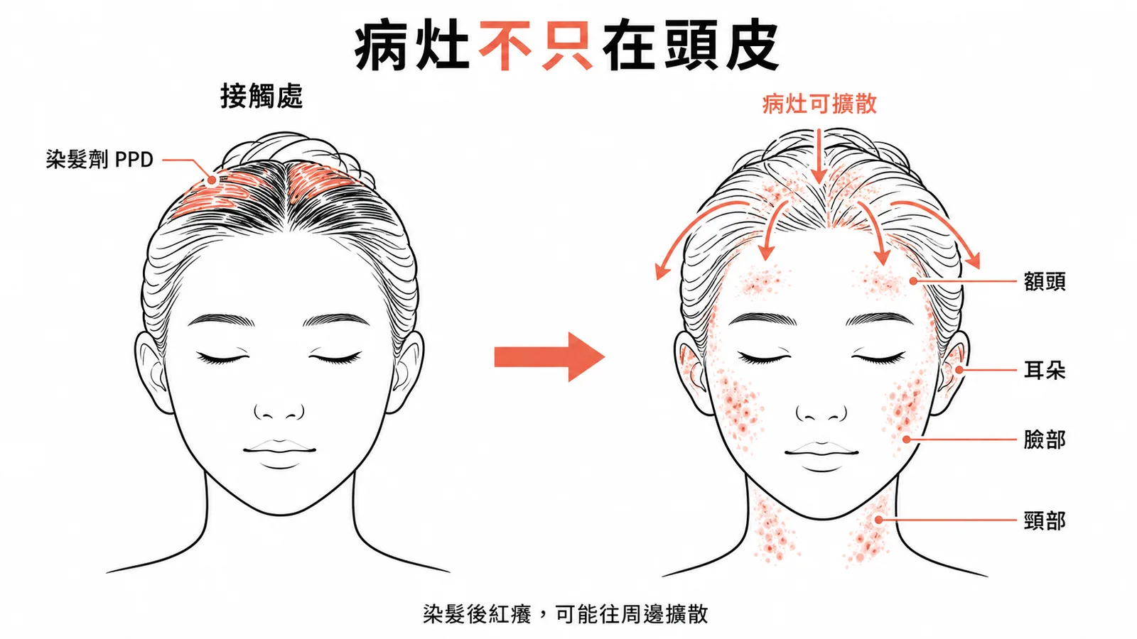 染髮劑過敏性皮膚炎病灶擴散示意圖