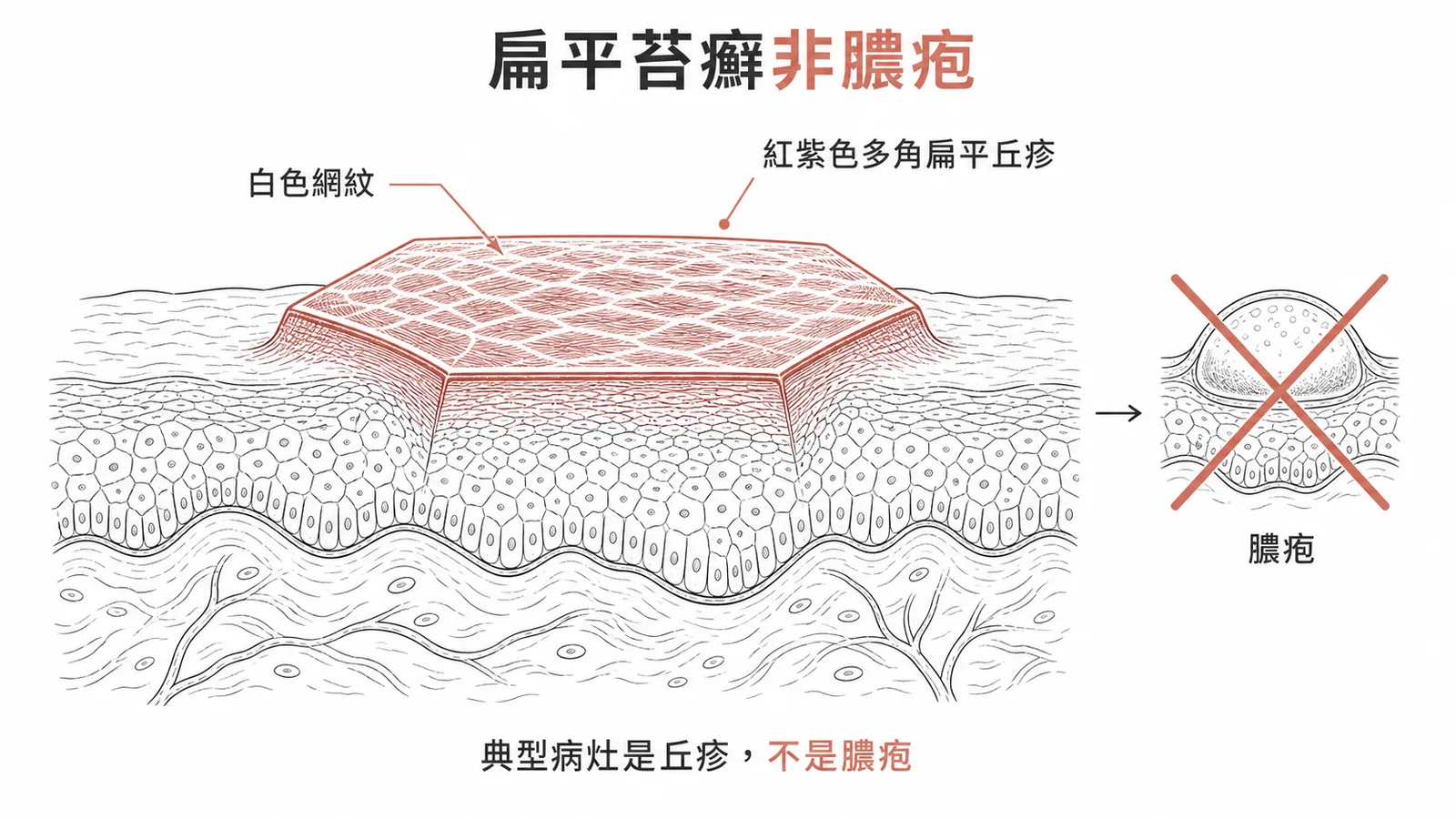 扁平苔癬典型丘疹特徵:紫色多角形非膿疱