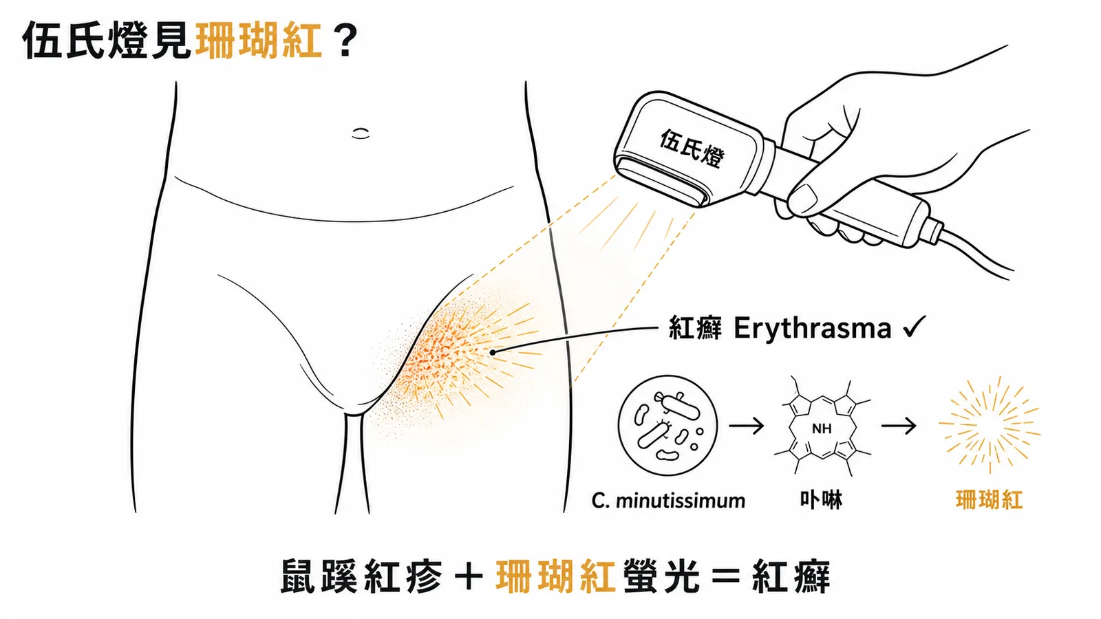 紅癬在伍氏燈下呈珊瑚紅螢光示意圖