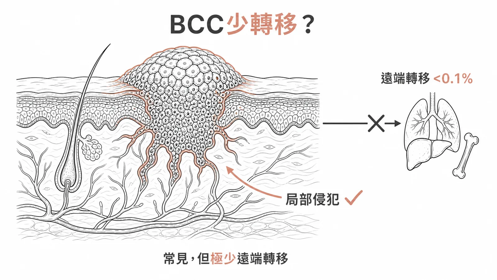 基底細胞癌轉移率極低的示意圖