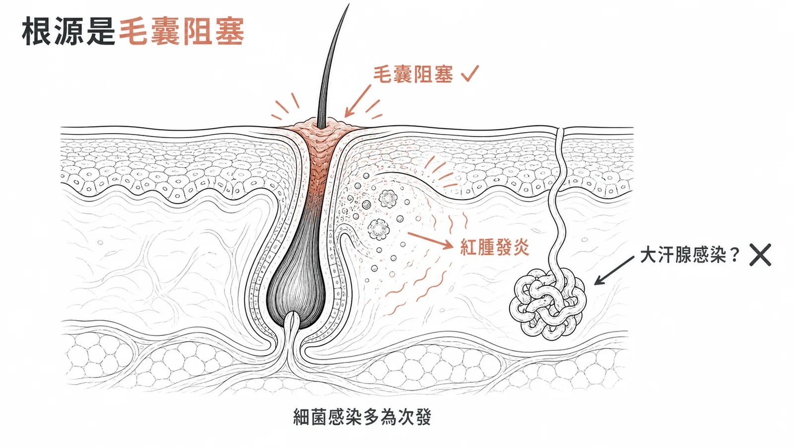 化膿性汗腺炎起因於毛囊阻塞的示意圖