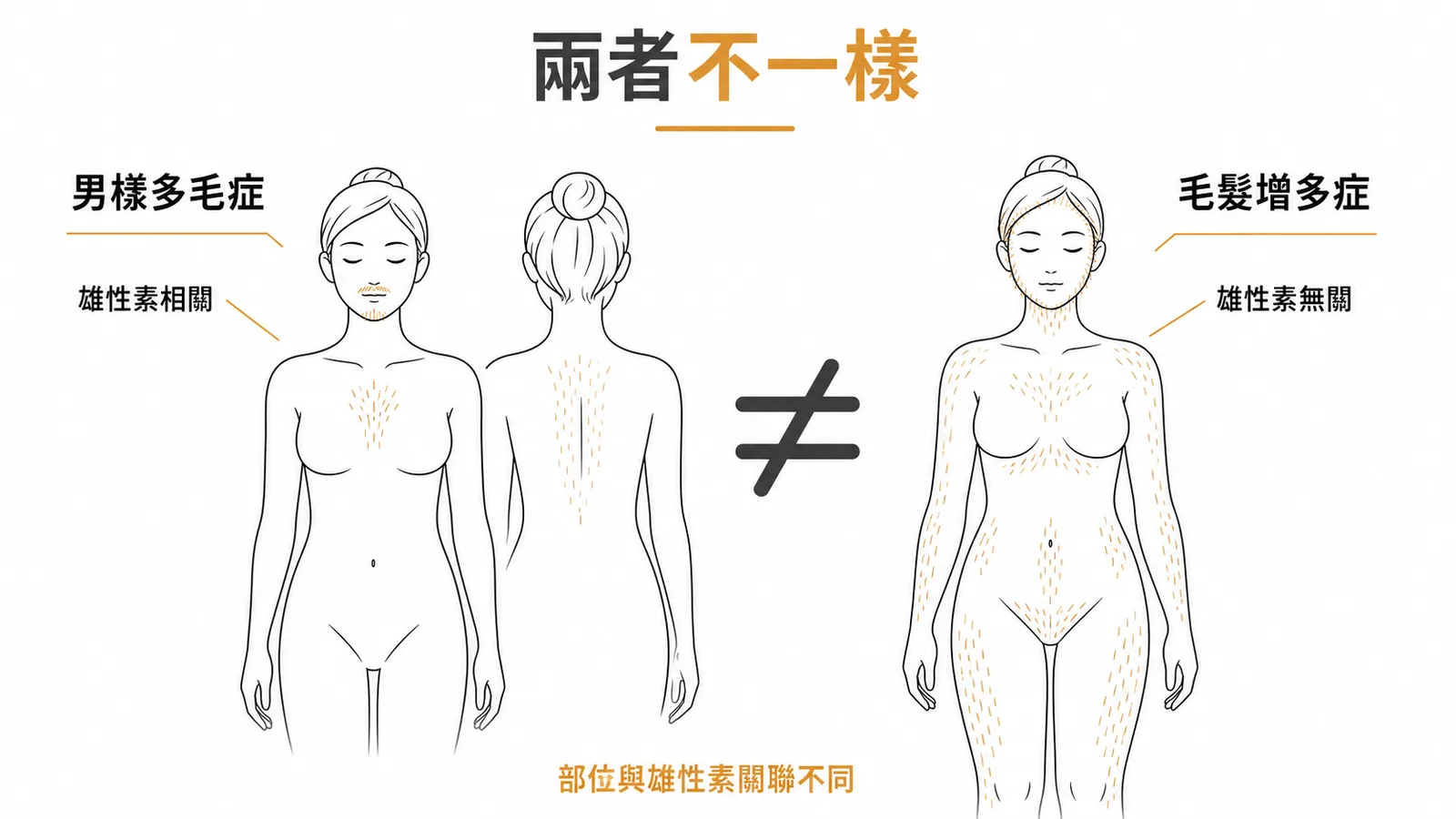 男樣多毛症與毛髮增多症的差異比較圖