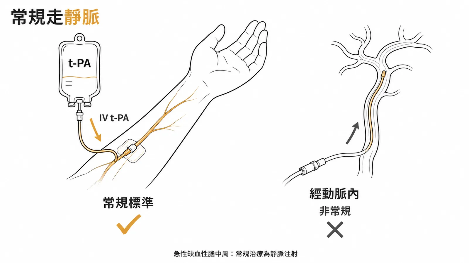 急性缺血性腦中風標準治療為靜脈注射 t-PA