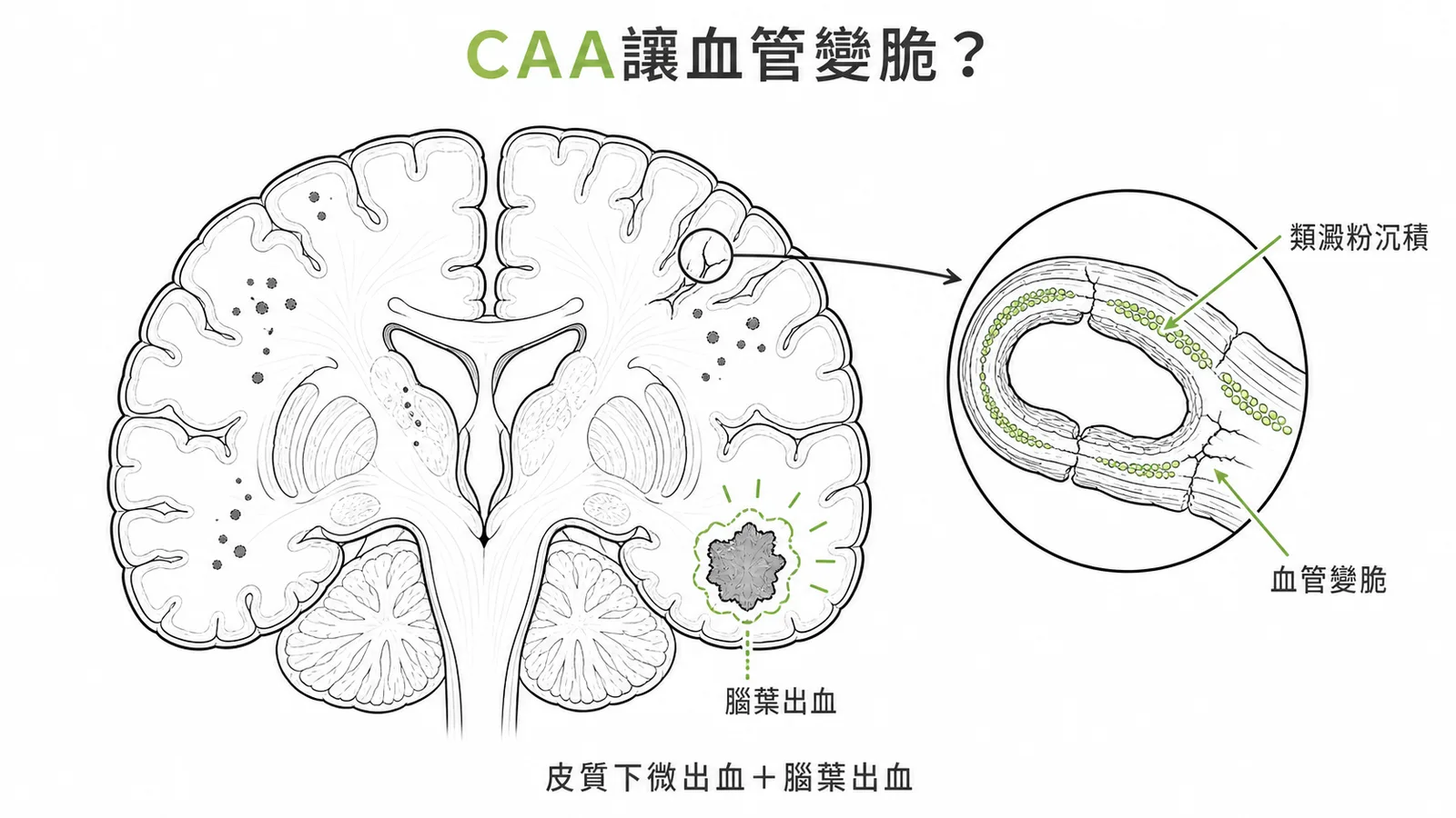 大腦類澱粉血管病變導致腦葉微出血的示意圖