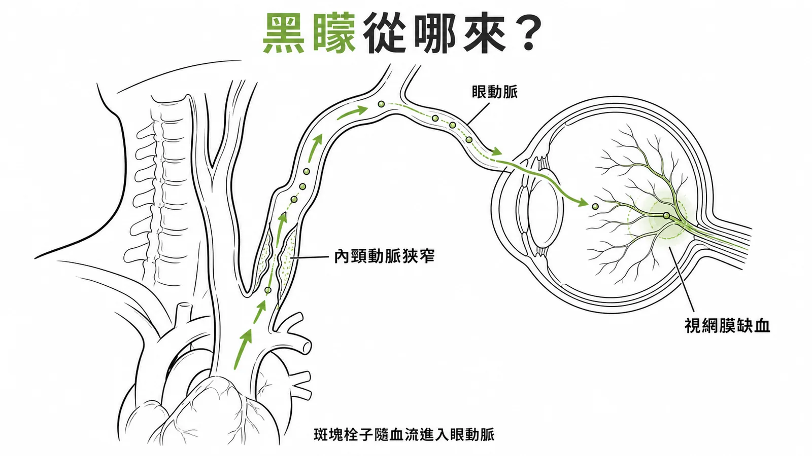 內頸動脈狹窄導致暫時性黑矇症的血管路徑圖