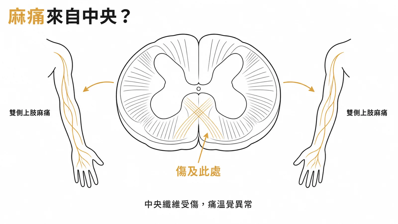 甩鞭式損傷傷及脊髓丘腦徑造成雙側上肢麻痛