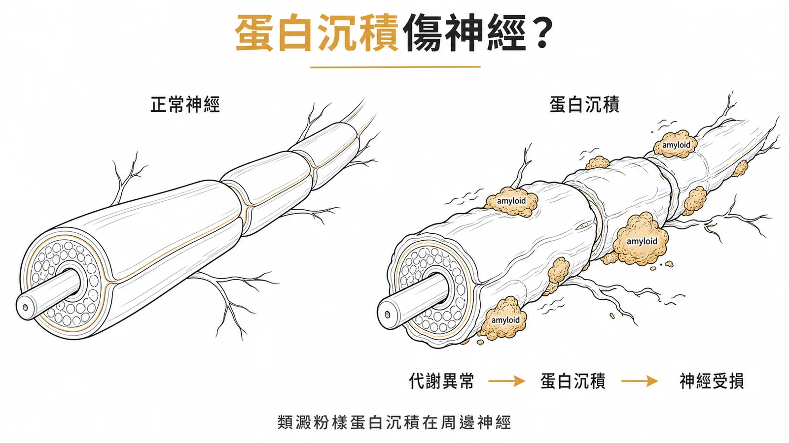 類澱粉樣蛋白沉積屬於代謝異常的周邊神經病變