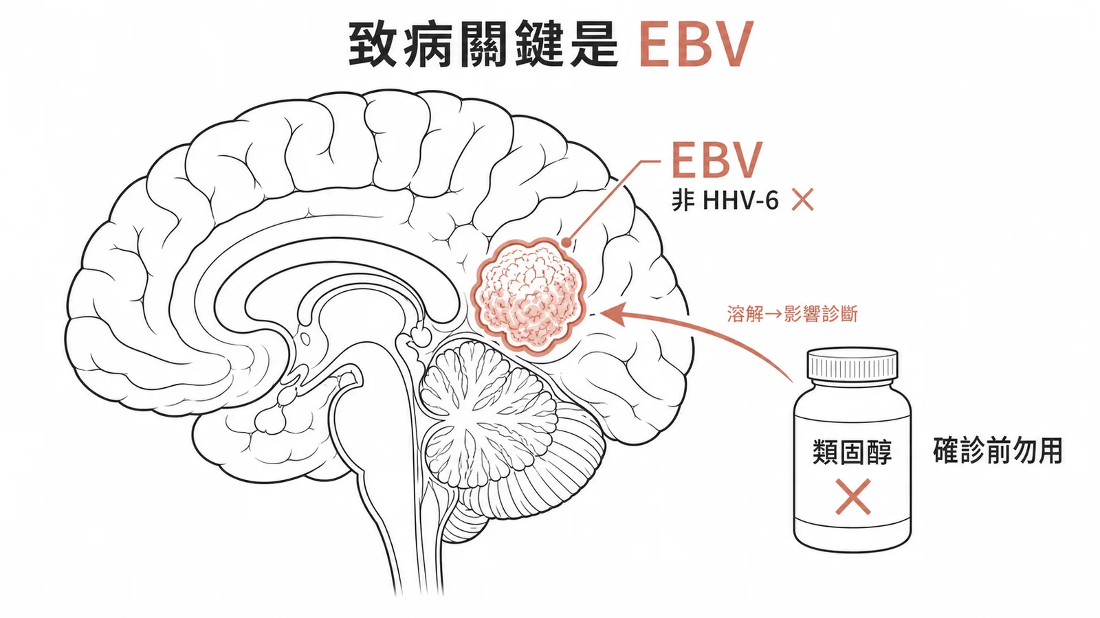 PCNSL確診前避免使用類固醇以免影響病理診斷