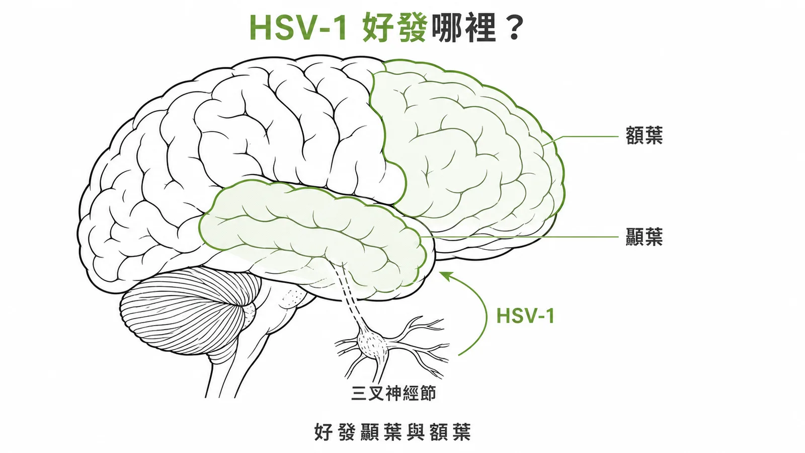 HSV-1是成人病毒性腦炎最常見病因且好發顳葉