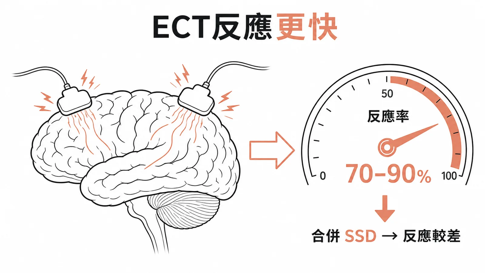 ECT 對重鬱症反應率高達 70-90%,合併身體症狀障礙反應較差