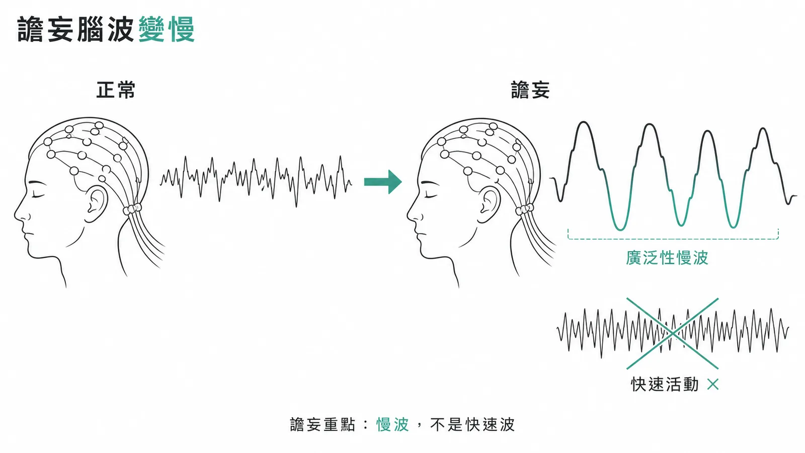 譫妄腦波為廣泛性慢波活動,非快速活動