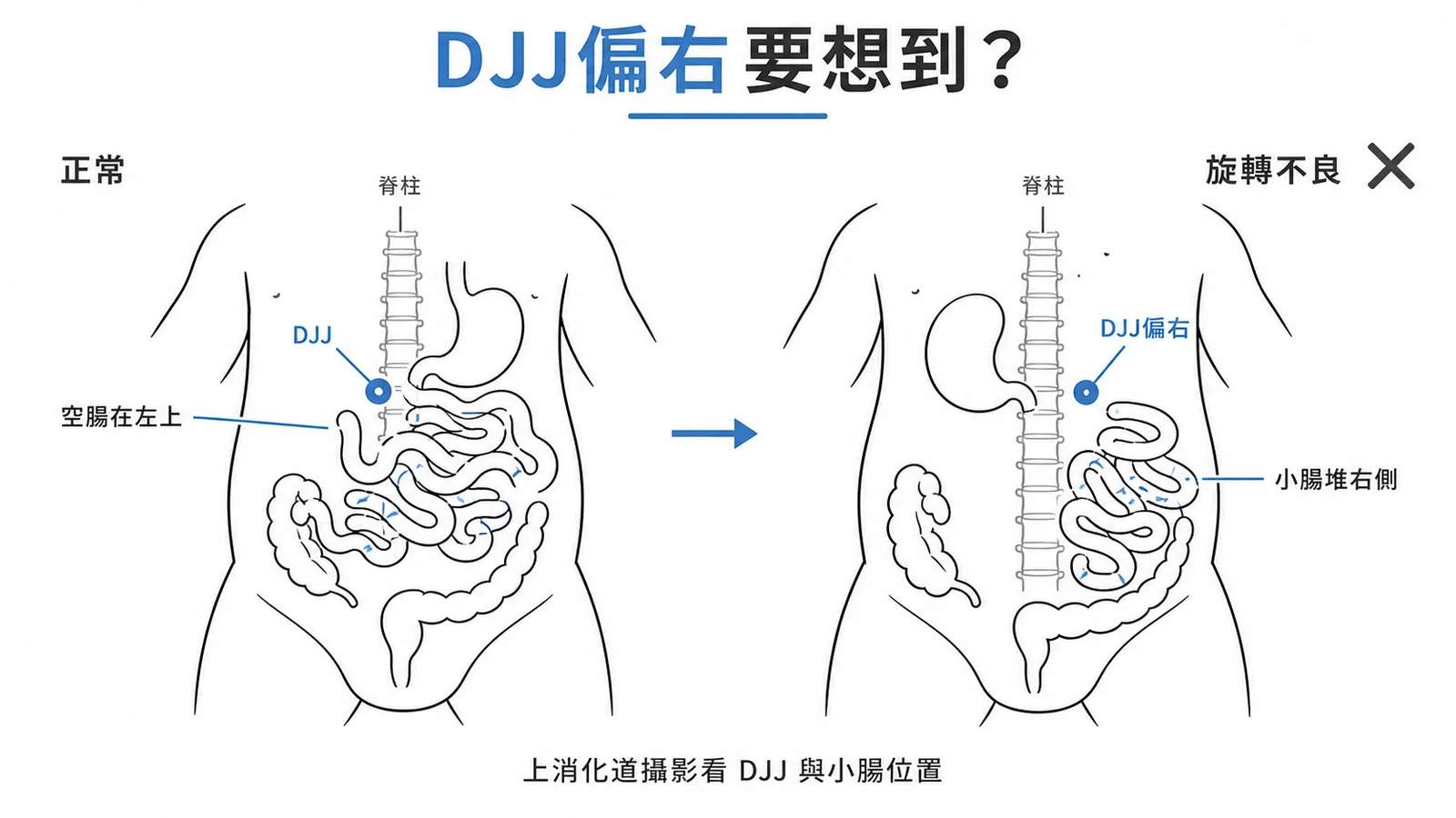 中腸旋轉不良影像特徵:小腸腸袢異常集中於右側