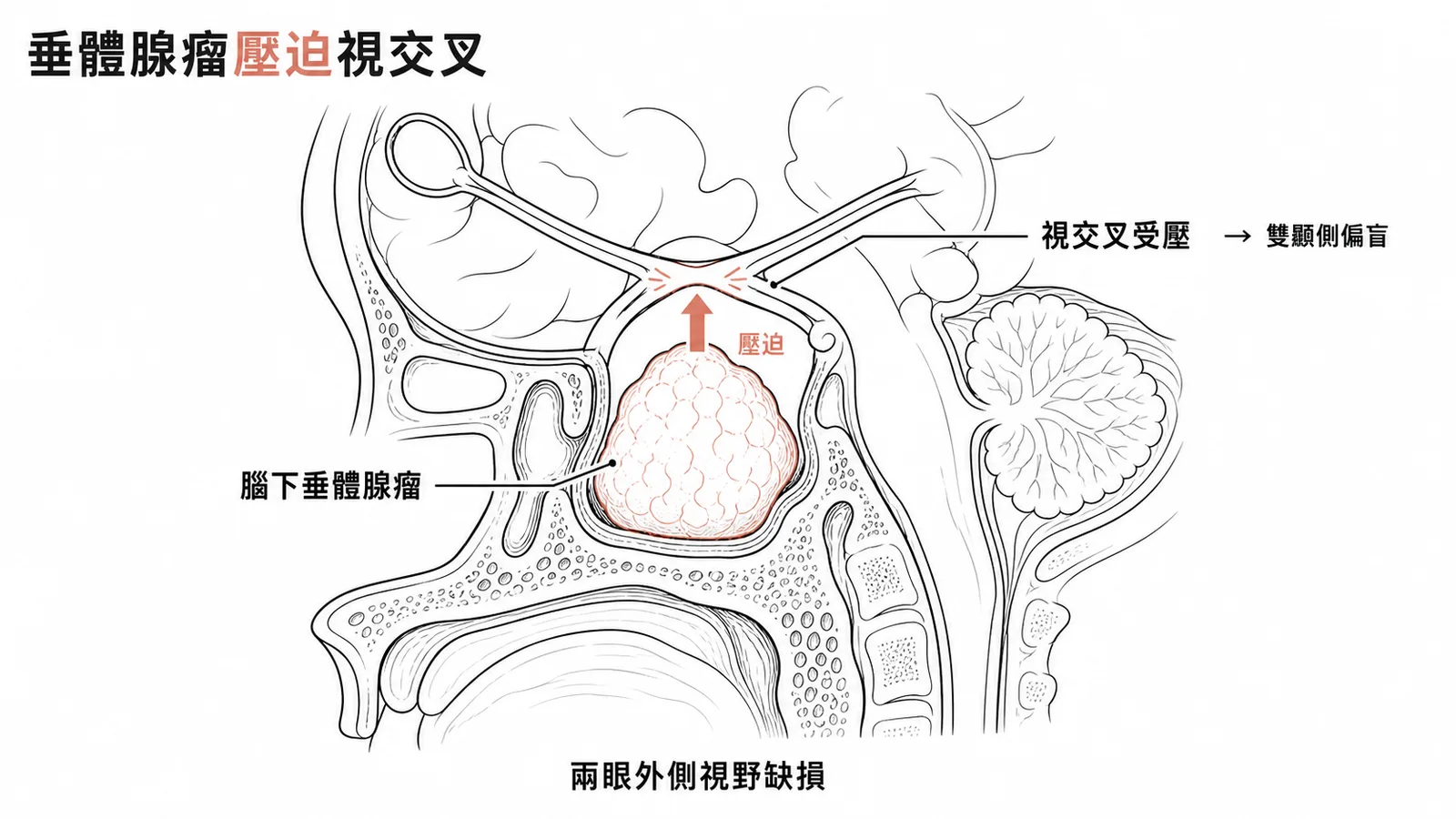 腦下垂體巨腺瘤從蝶鞍區向上壓迫視交叉導致雙顳側偏盲