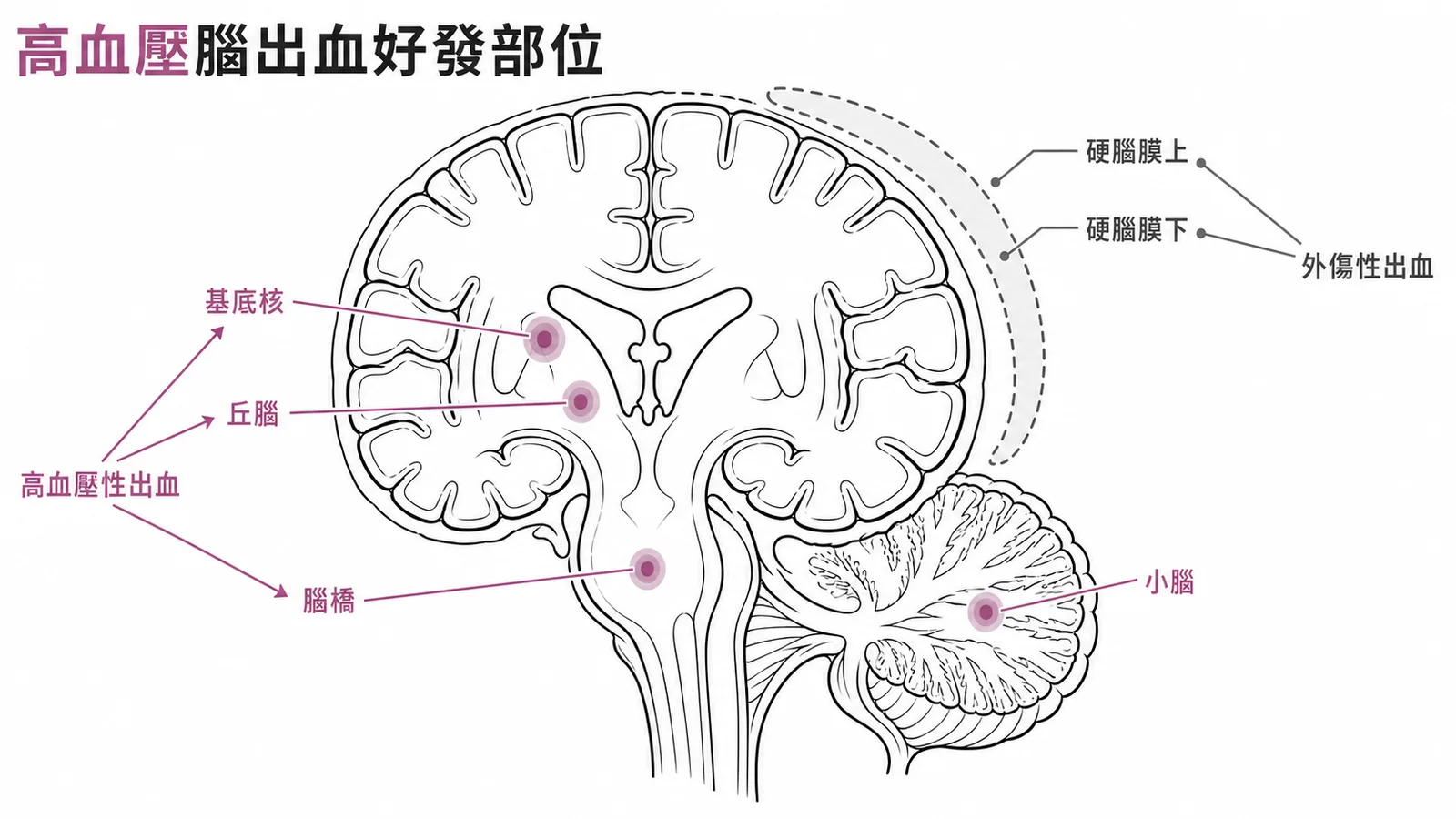 高血壓性腦出血好發部位：基底核、丘腦、腦橋、小腦