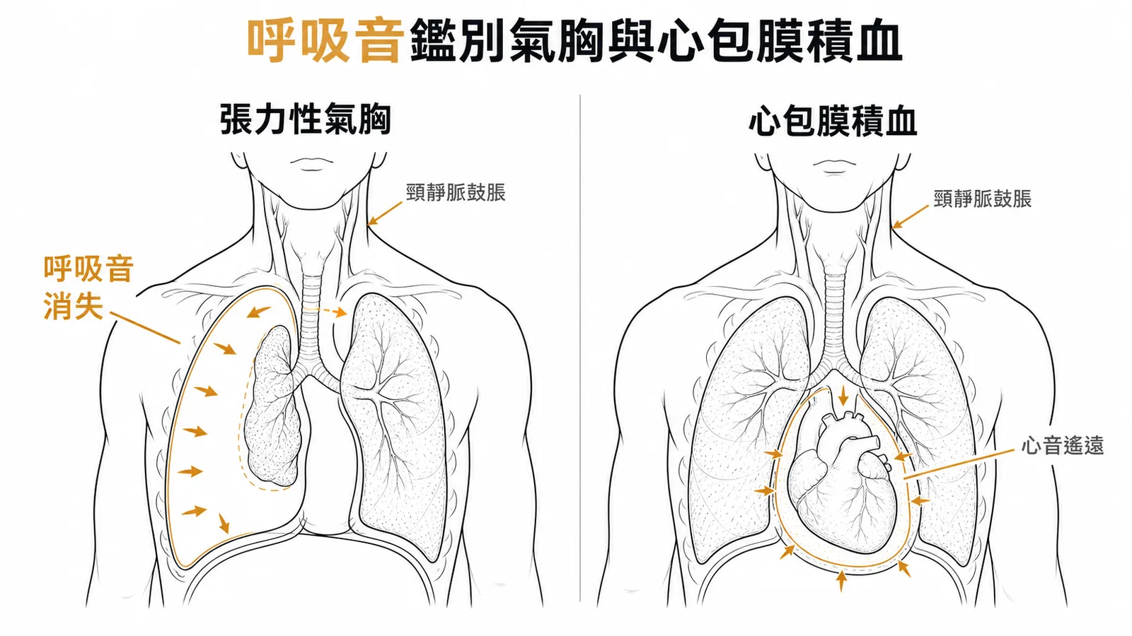 呼吸音鑑別張力性氣胸與心包膜積血