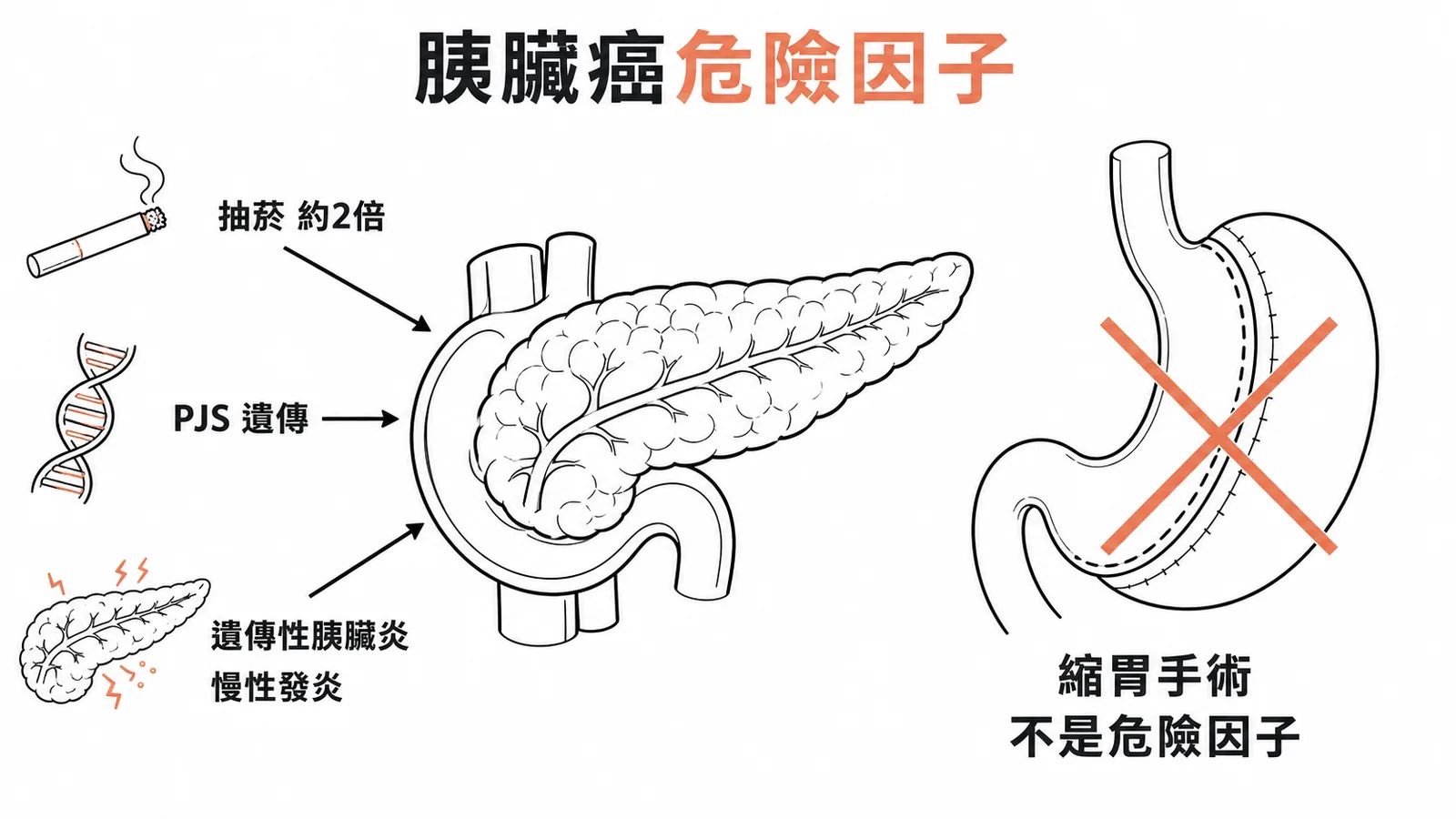 胰臟癌危險因子：抽菸、PJS、遺傳性胰臟炎，縮胃手術非危險因子