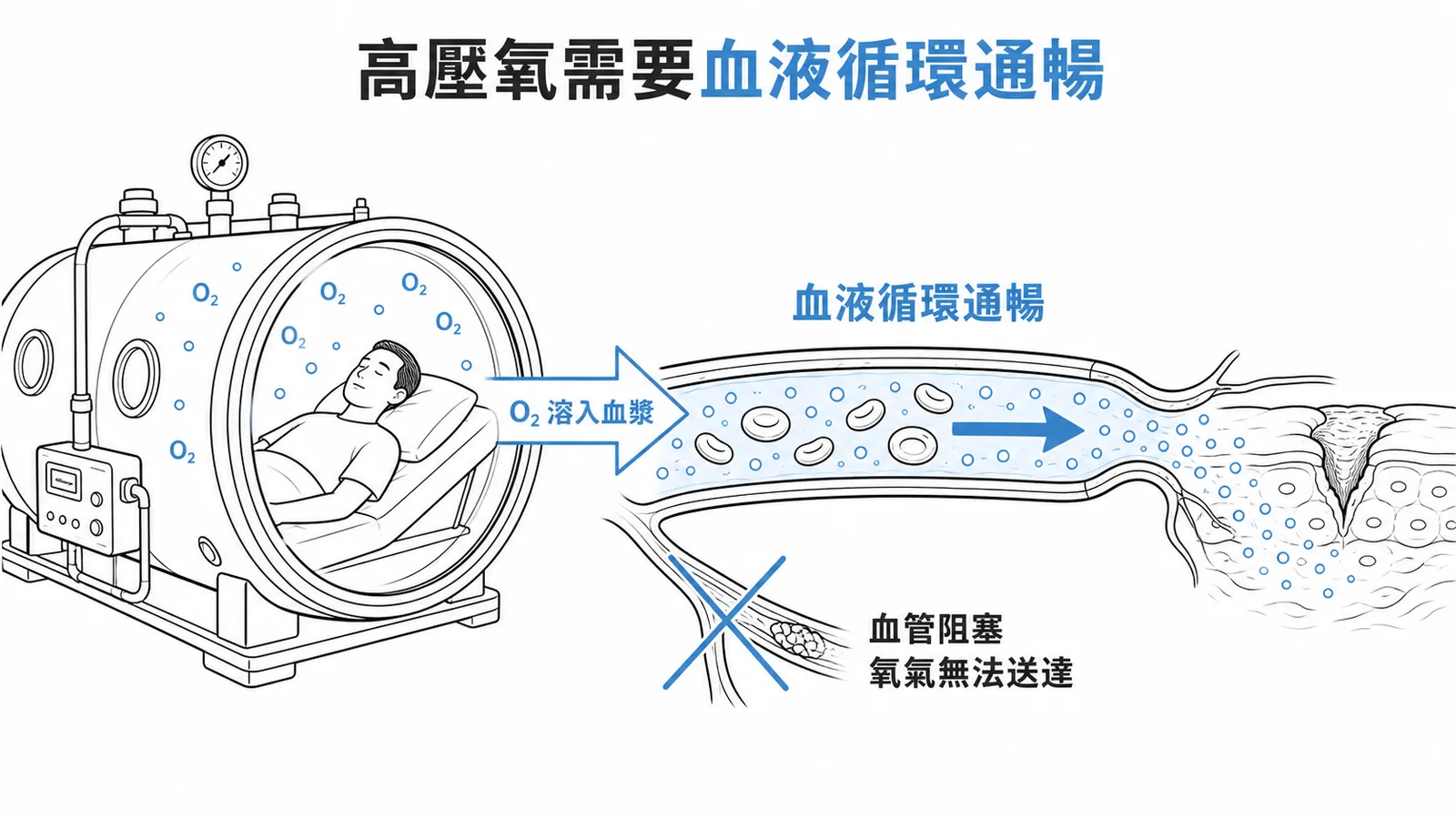 高壓氧治療需要目標組織血液循環通暢才能送氧
