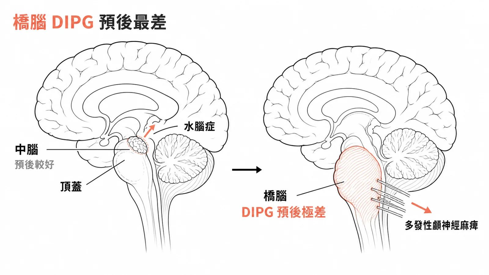 橋腦 DIPG 預後最差，中腦膠質瘤預後較好
