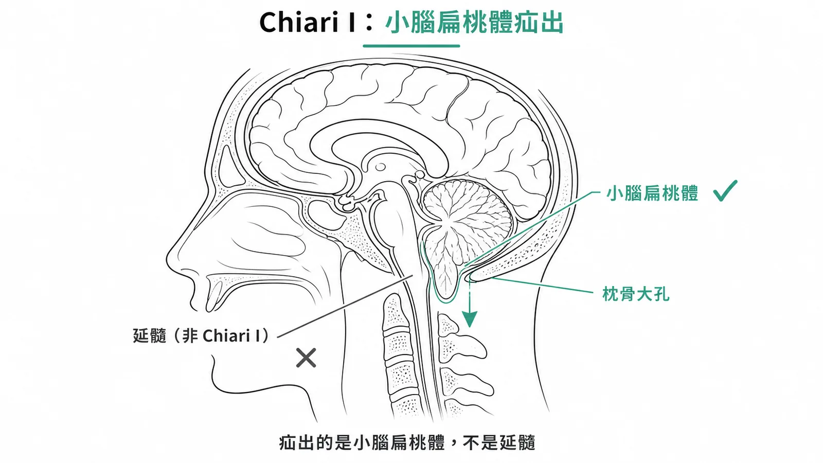 Chiari I 型畸形:小腦扁桃體向下疝出穿過枕骨大孔,非延髓
