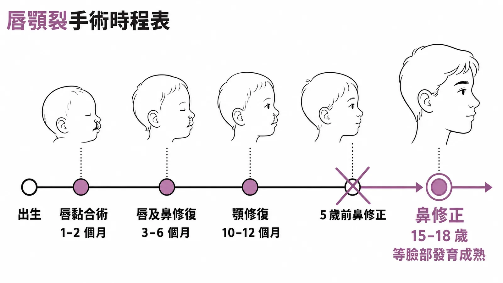 唇顎裂修復手術時程：鼻修正等青春期後15至18歲