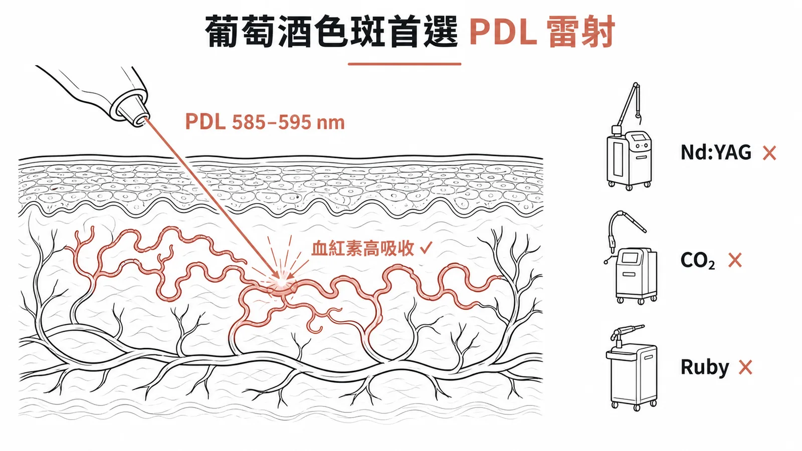 葡萄酒色斑首選PDL脈衝式染料雷射精準破壞微血管