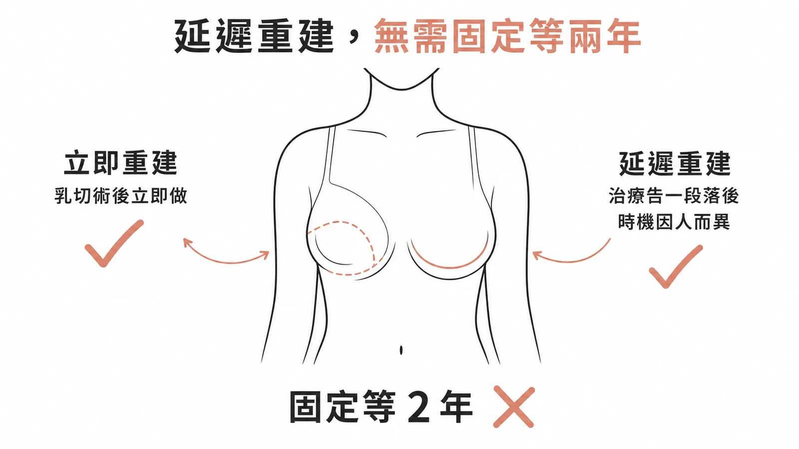 乳房延遲重建時機因人而異無需固定等兩年