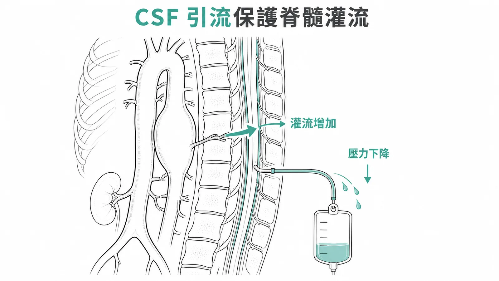 CSF引流降低脊髓腔壓力保護灌流示意圖