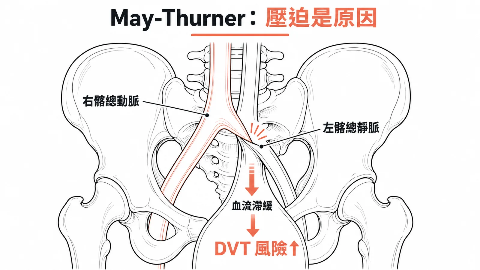 May-Thurner syndrome右髂動脈壓迫左髂靜脈導致DVT示意圖
