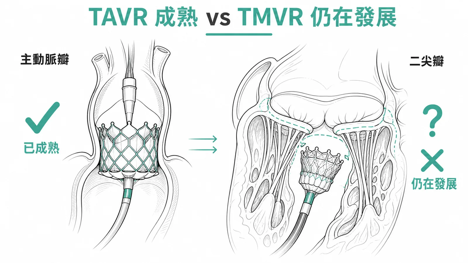 TAVR成熟vs TMVR仍在發展對照示意圖