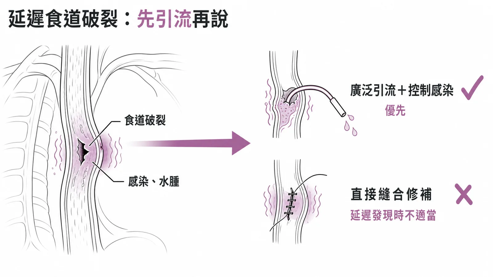 延遲食道破裂先引流控制感染再修補示意圖