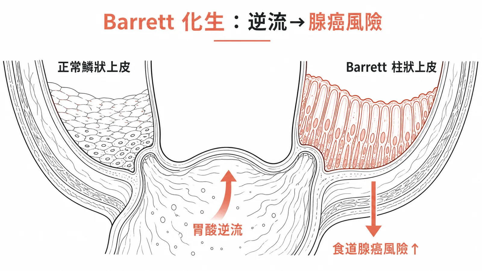 Barrett食道鱗狀上皮化生為柱狀上皮增加腺癌風險示意圖