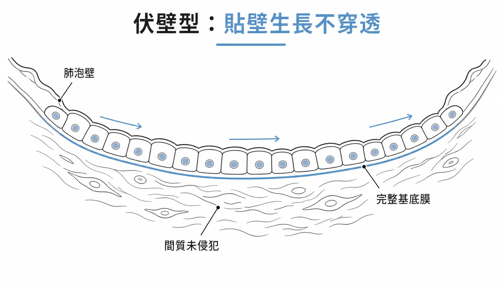 肺腺癌原位癌lepidic伏壁型沿肺泡壁生長示意圖