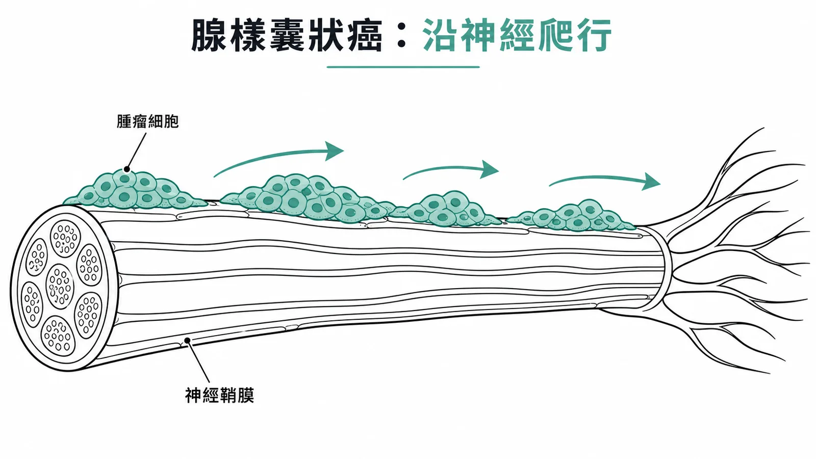 腺樣囊狀癌沿神經鞘膜爬行擴散示意圖