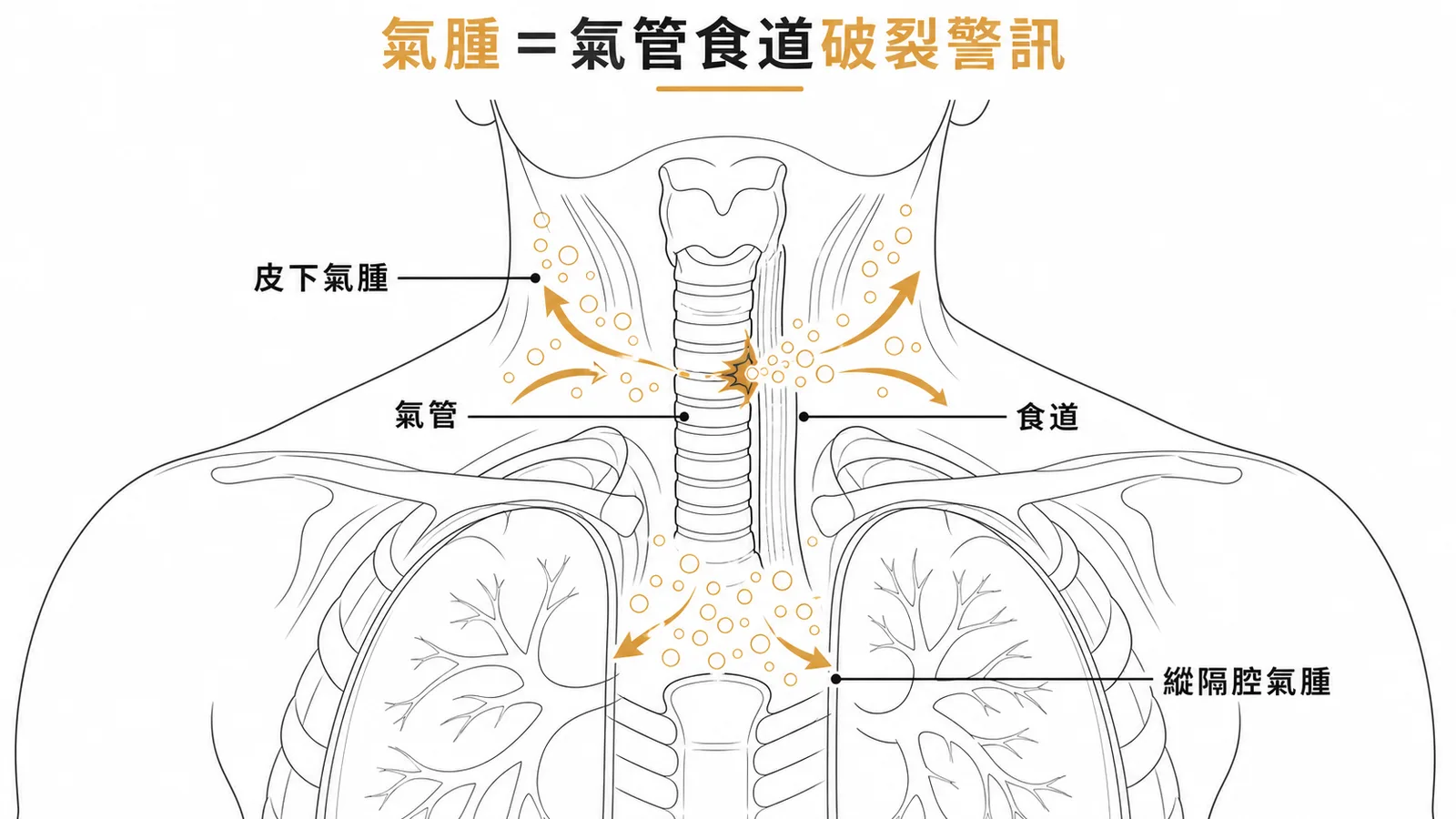 皮下氣腫與縱隔腔氣腫提示氣管食道破裂示意圖