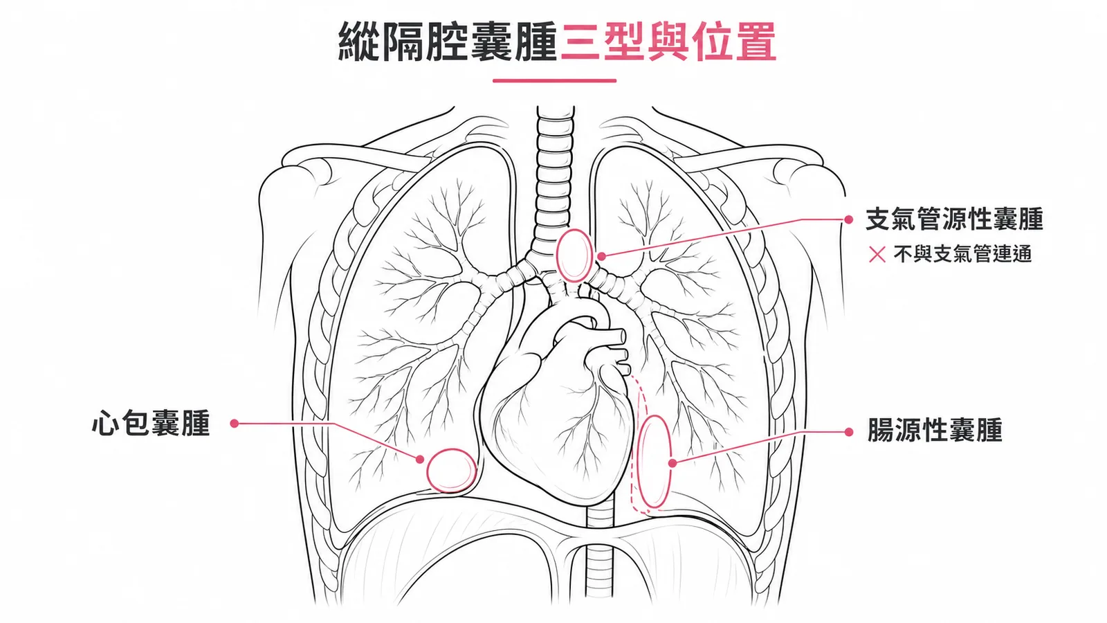 縱隔腔囊腫三型位置與支氣管源性囊腫不連通示意圖