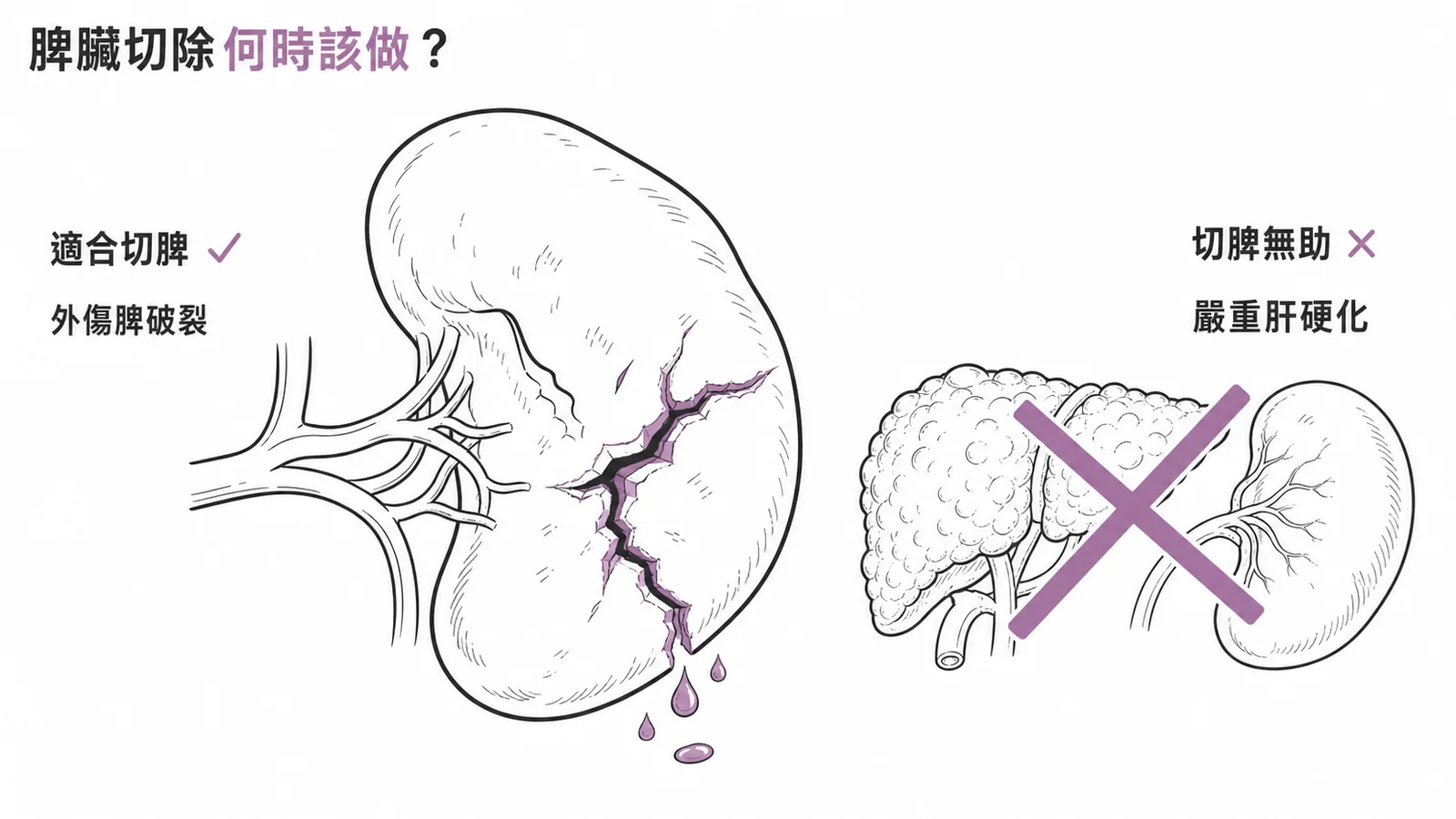 脾臟切除適應症與禁忌對照：外傷脾破裂適合切脾，嚴重肝硬化切脾無助