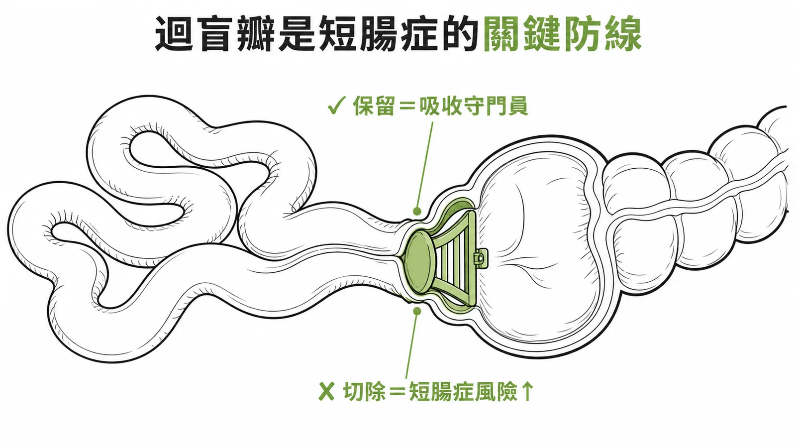 迴盲瓣是短腸症的關鍵防線：保留可守住吸收功能，切除則風險大增