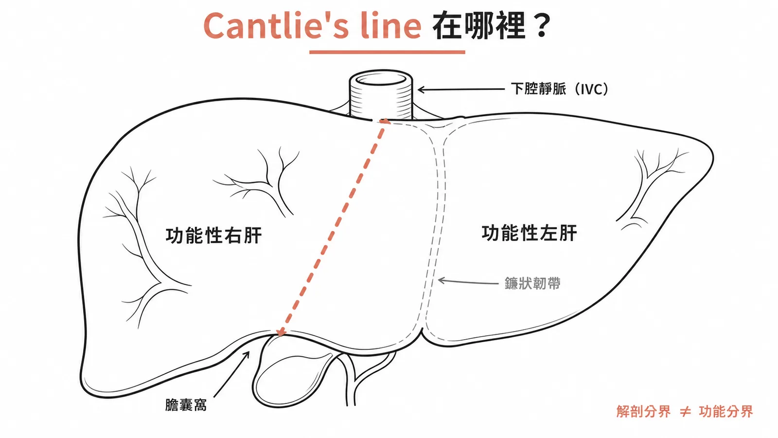 Cantlie's line 從膽囊窩連至下腔靜脈,劃分肝臟功能性左右葉