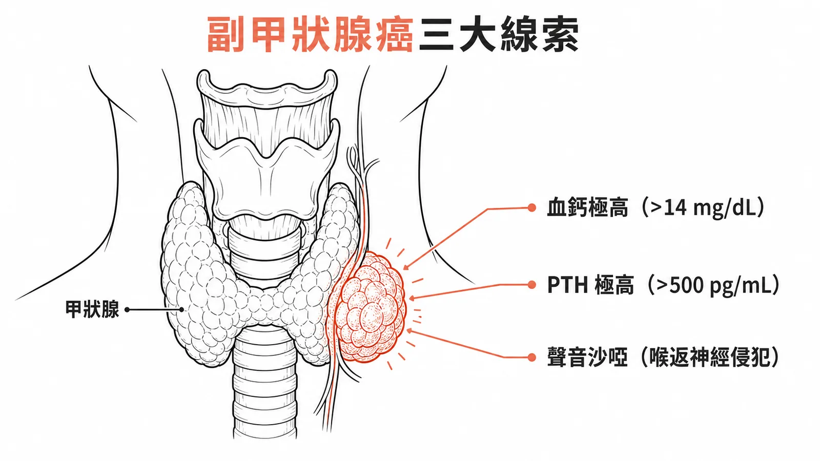 副甲狀腺癌三大線索：血鈣極高、PTH極高、聲音沙啞