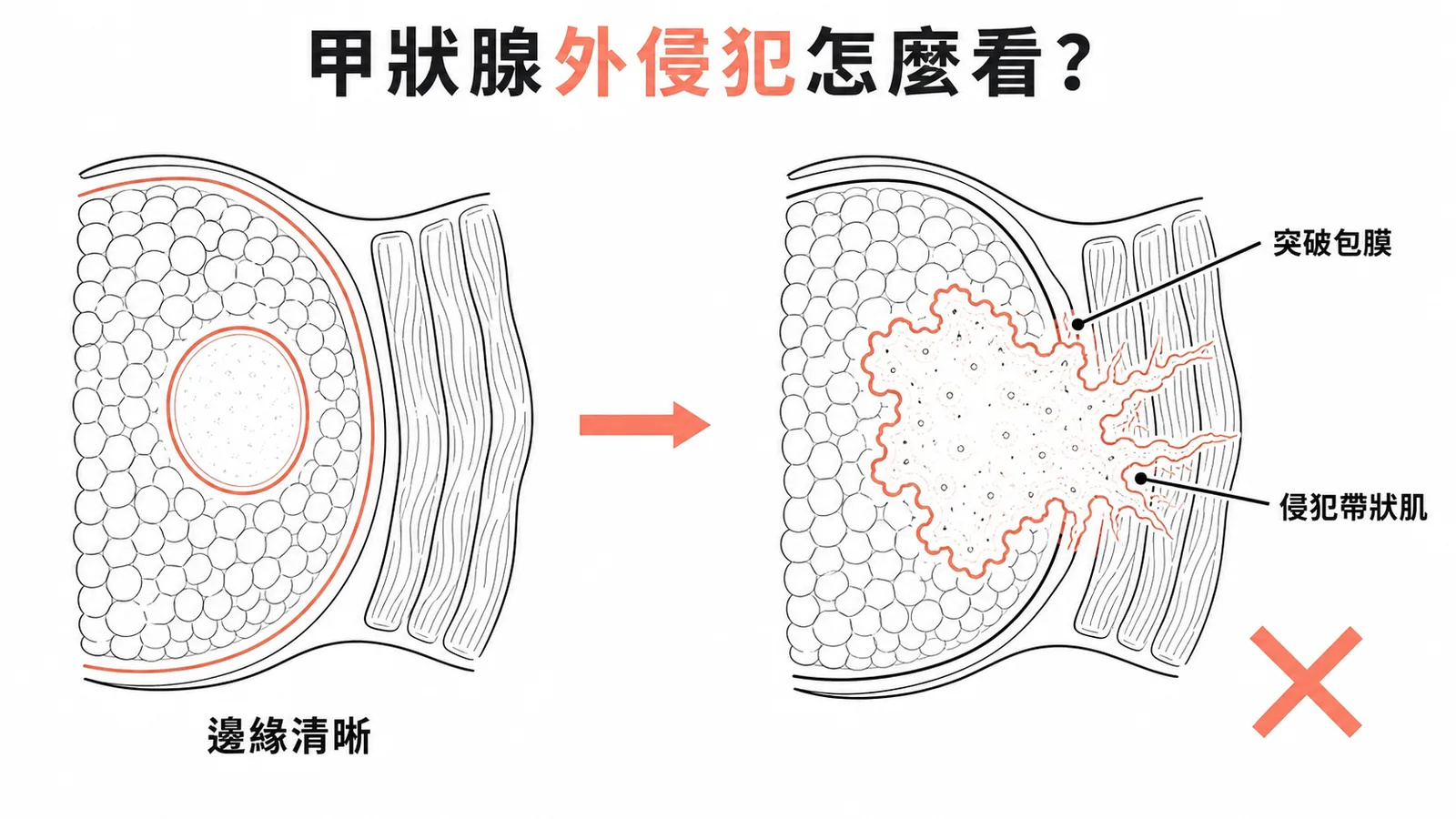 甲狀腺外侵犯示意：正常邊緣清晰 vs 異常突破包膜侵犯帶狀肌