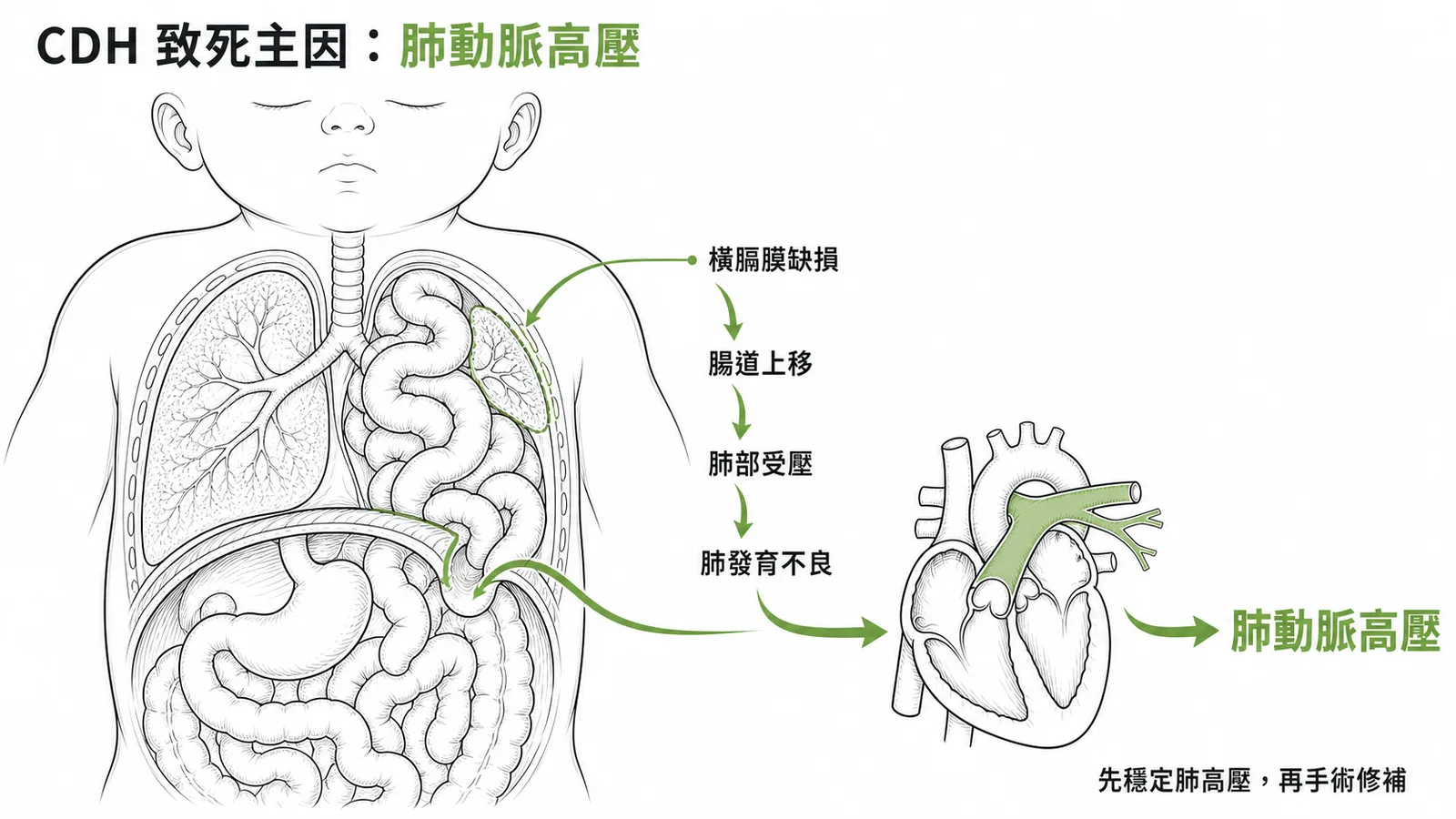 CDH 致死主因：橫膈膜缺損致腸道上移壓迫肺部引發肺動脈高壓