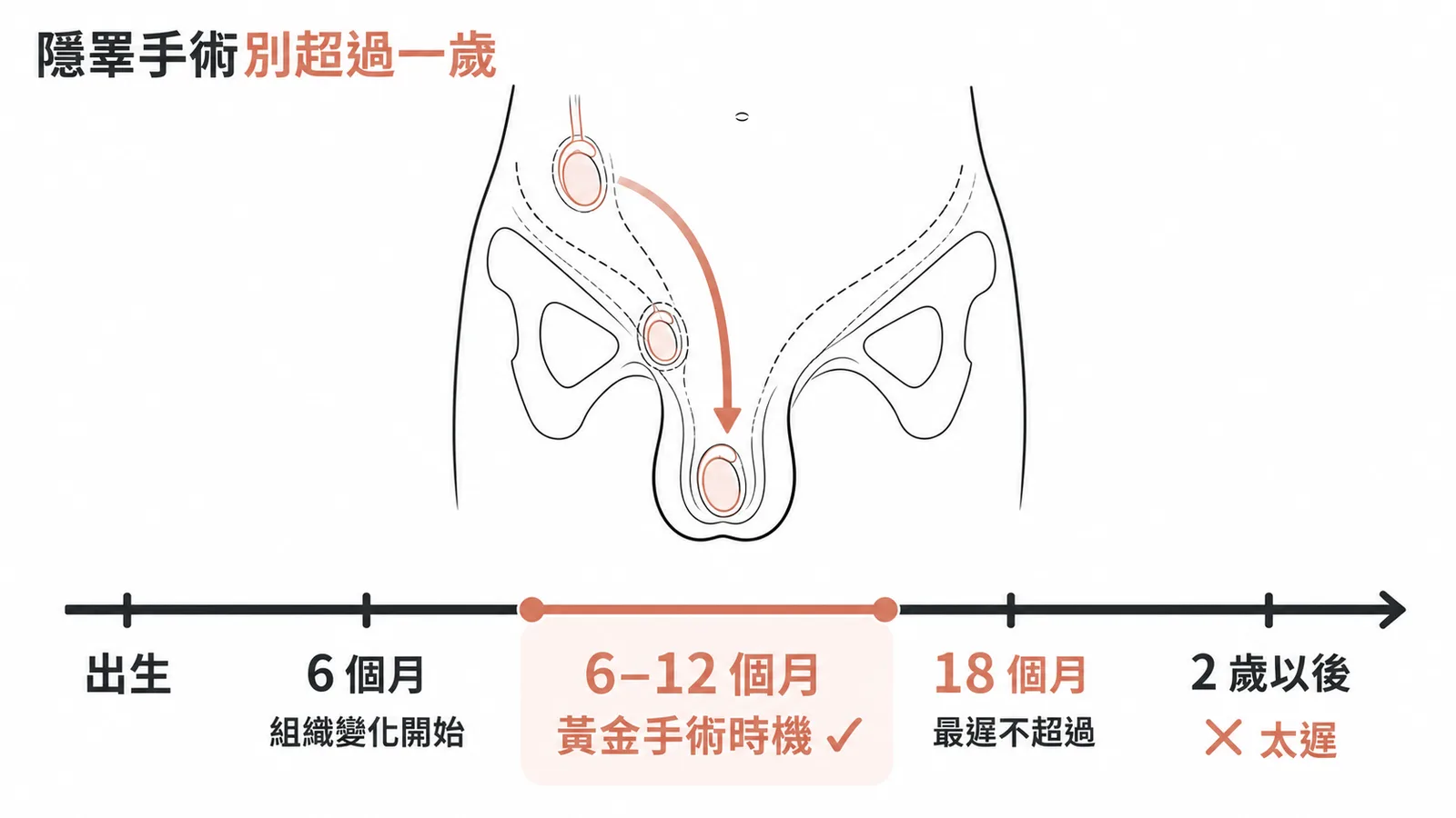 隱睪手術黃金時機 6-12 個月，最遲不超過 18 個月