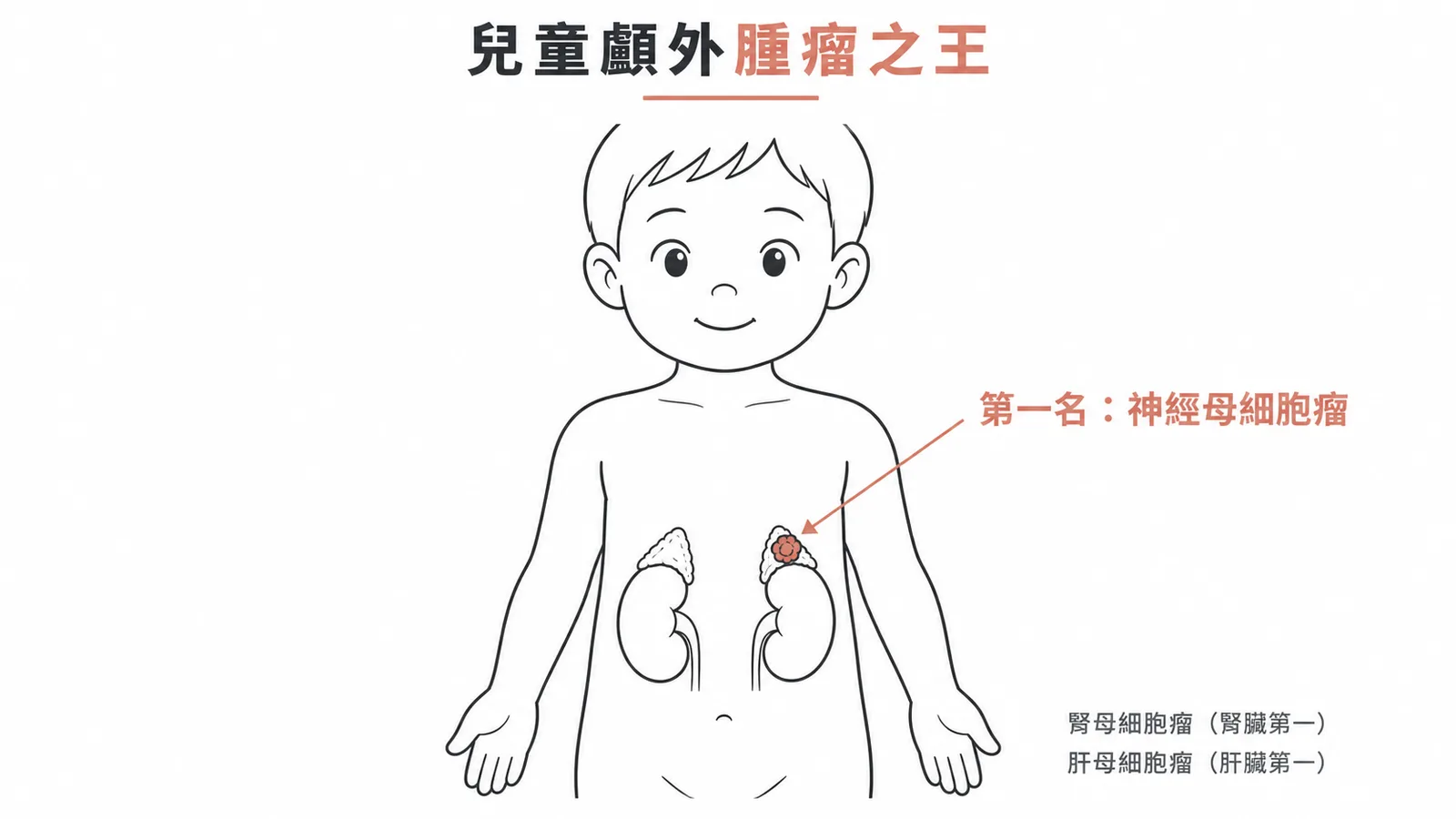 兒童最常見顱外實質腫瘤：神經母細胞瘤，好發腎上腺