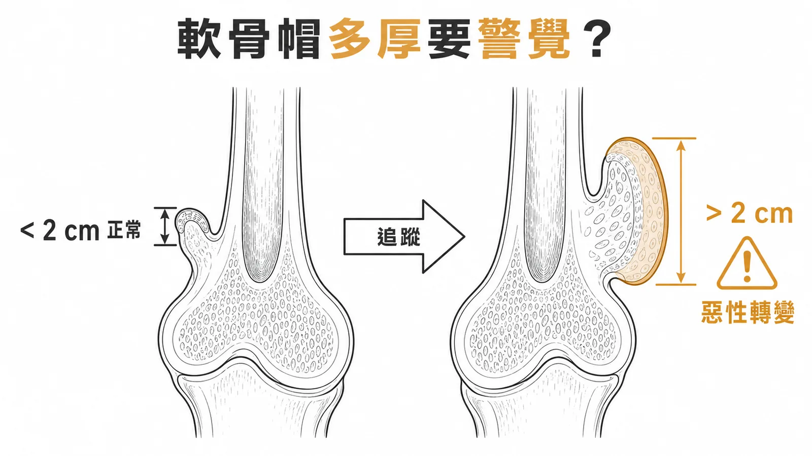 骨軟骨瘤軟骨帽厚度對照:小於2公分為正常,大於2公分應警覺惡性轉變為軟骨肉瘤