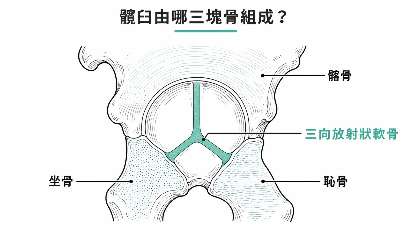 髖臼解剖示意圖:由髂骨、坐骨、恥骨三塊骨在三向放射狀軟骨處融合而成