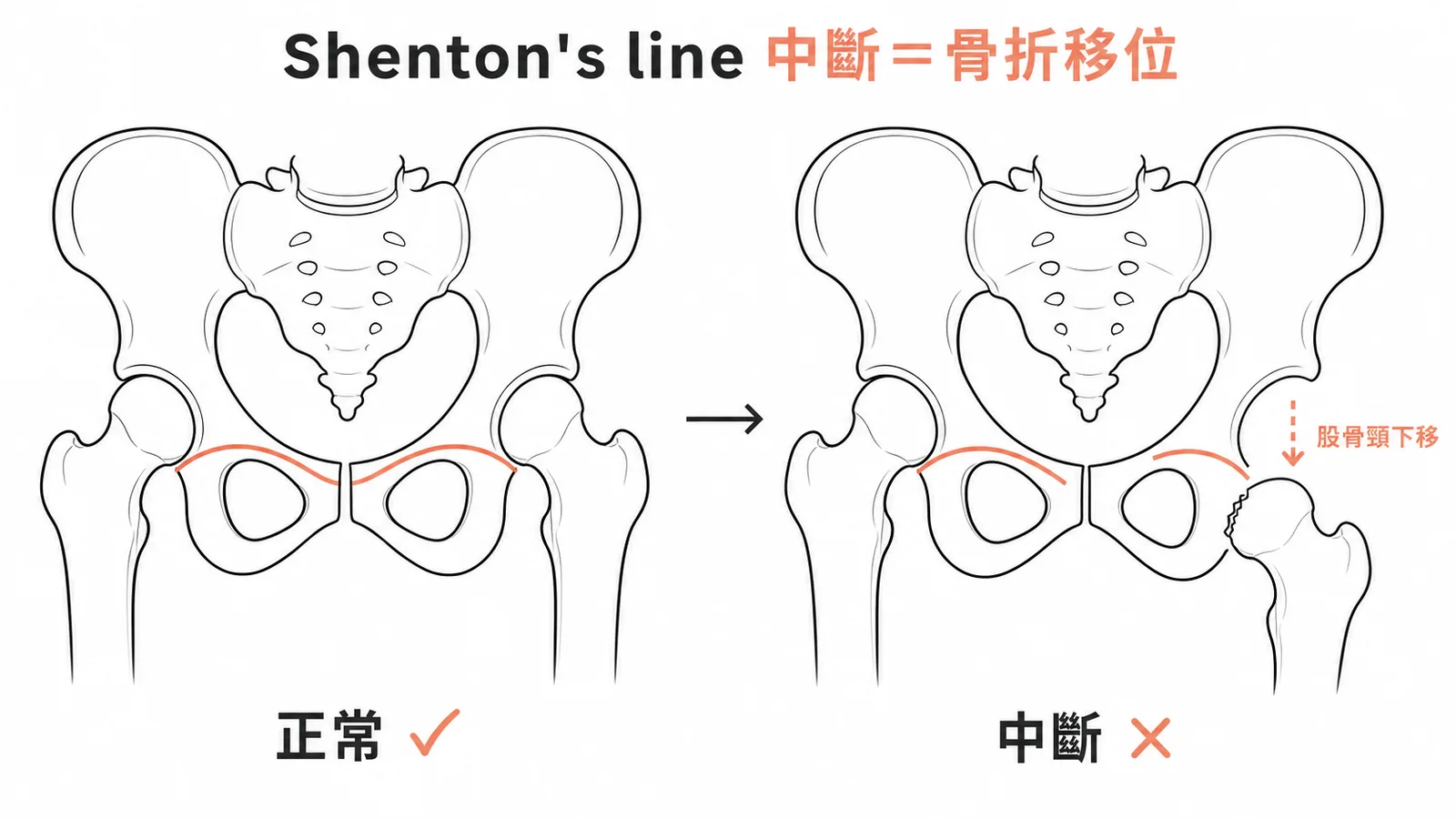 Shenton's line正常與中斷的左右對照示意圖